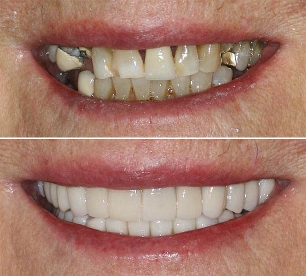Helen Before after