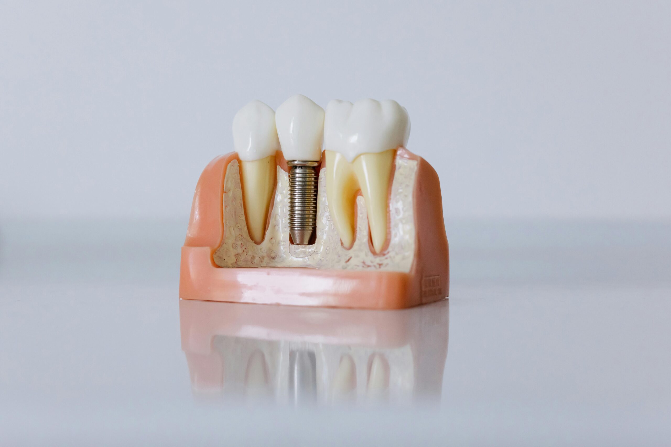 Dental Implant Kensington Square Dental