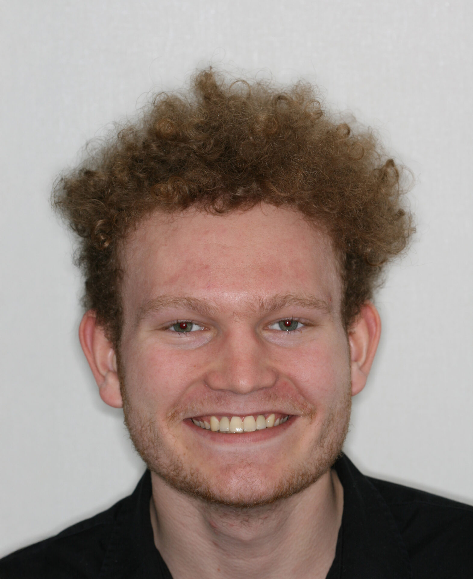 Dental Implants, Kensington Dental Burnaby